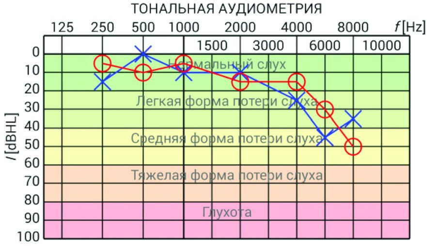 Исследование слуха: аудиометрия